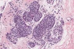 Lobular carcinoma in situ of the breast