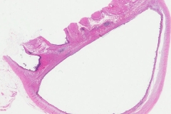 Low grade appendiceal mucinous neoplasm