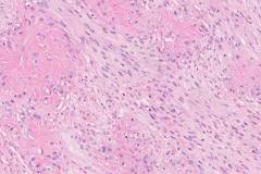 Low grade fibromyxoid sarcoma