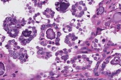 Low grade serous carcinoma of the ovary