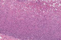 Low grade squamous intraepithelial lesion of the cervix