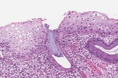 Low grade squamous intraepithelial lesion of the cervix