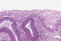 Low grade squamous intraepithelial lesion of the cervix
