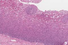 Low grade squamous intraepithelial lesion of the cervix