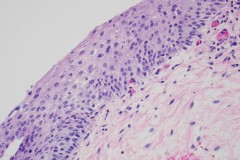 Low grade squamous intraepithelial lesion of the vagina