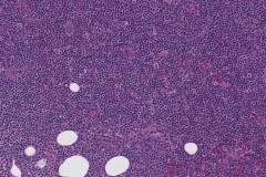 Lymphoplasmacytic lymphoma