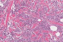 Mammary-type myofibroblastoma