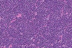 Mantle cell lymphoma