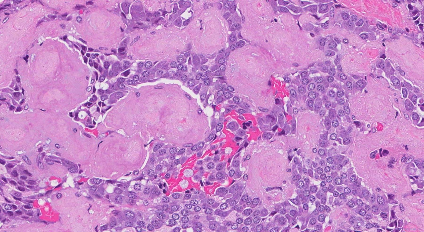 Medullary Thyroid Carcinoma Atlas Of Pathology medullary-thyroid-carcinoma-atlas-of-pathology