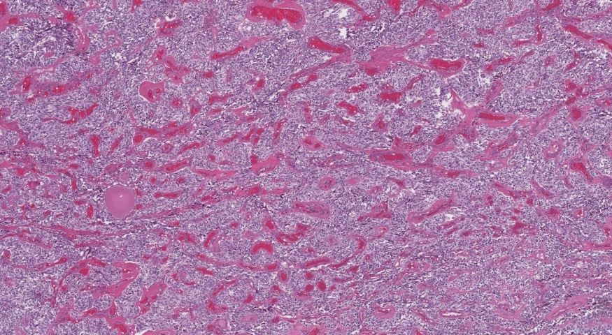 Medullary thyroid carcinoma