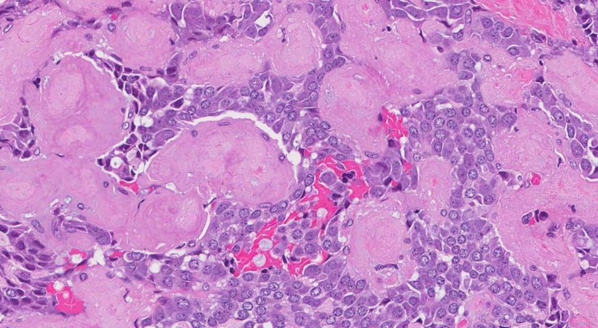 Medullary thyroid carcinoma
