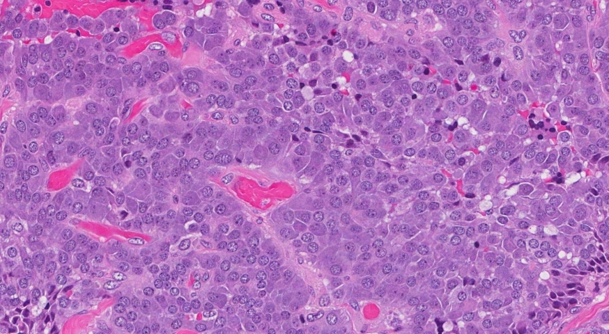 Medullary thyroid carcinoma