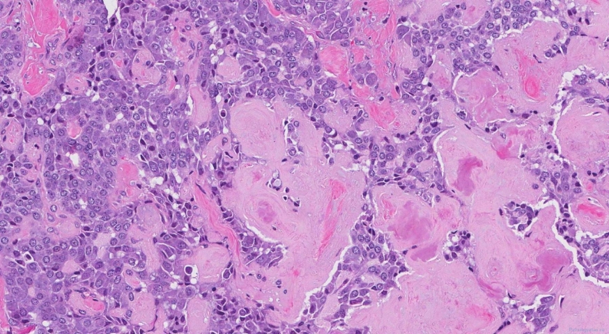 Medullary thyroid carcinoma