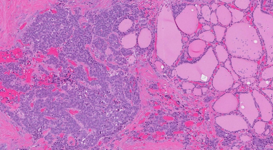 Medullary thyroid carcinoma