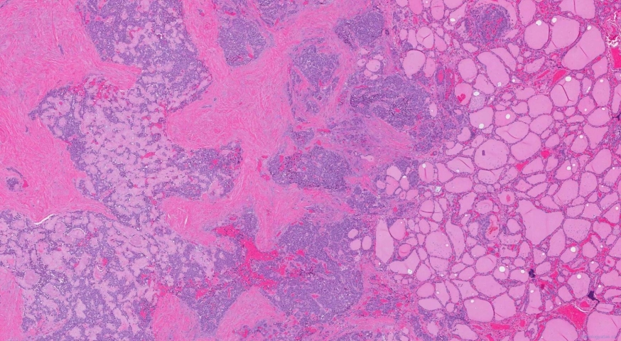 Medullary thyroid carcinoma