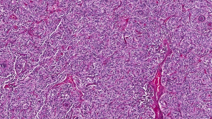 Medullary thyroid carcinoma