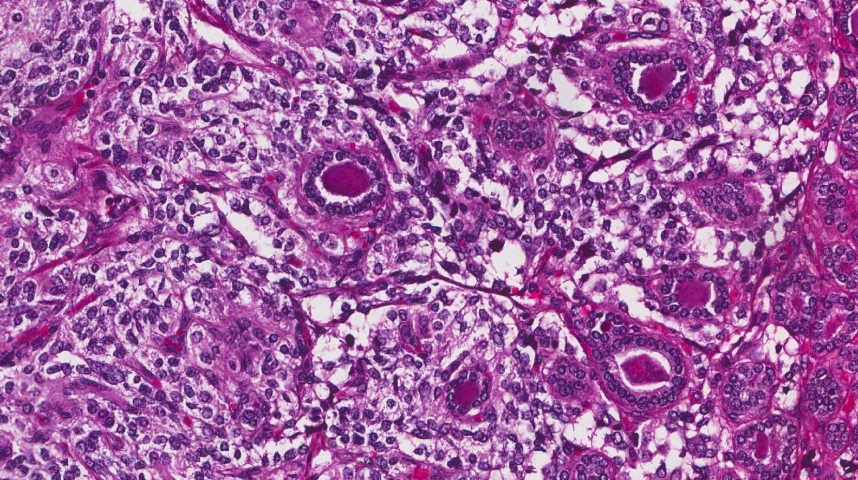 Medullary thyroid carcinoma