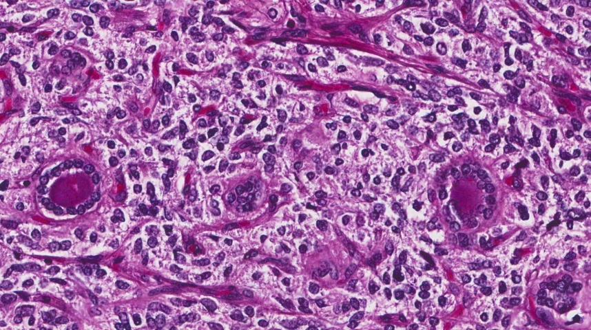 Medullary thyroid carcinoma