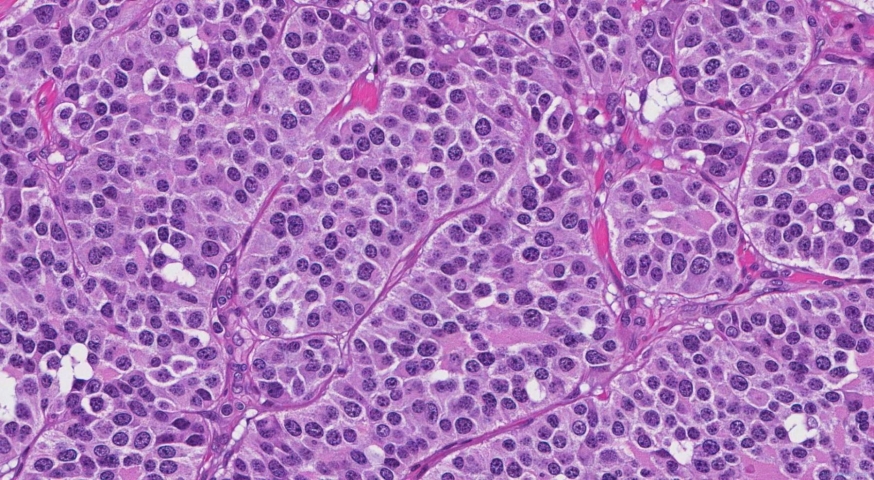 Medullary thyroid carcinoma