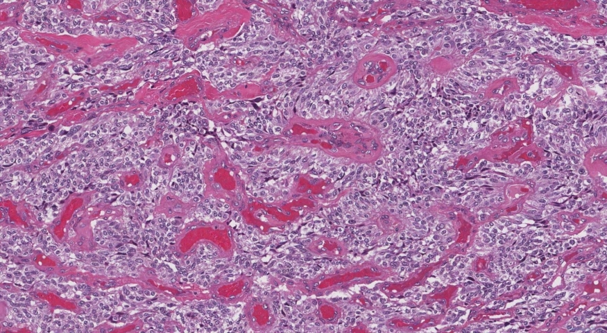Medullary thyroid carcinoma