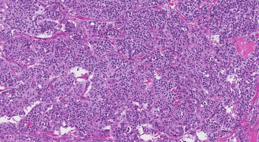 Medullary thyroid carcinoma
