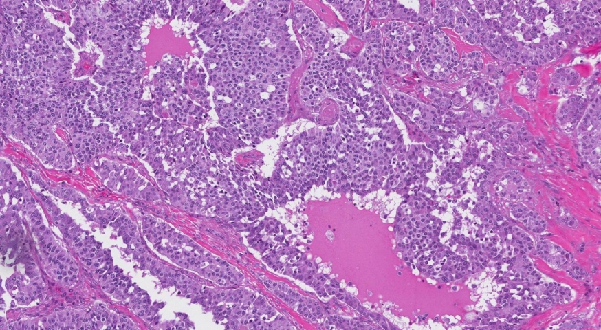 Medullary thyroid carcinoma