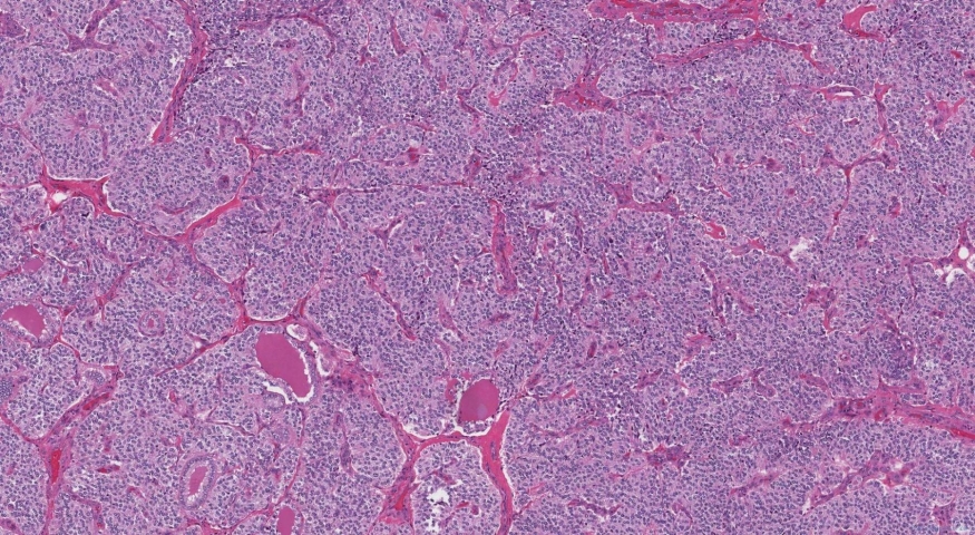 Medullary thyroid carcinoma