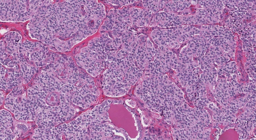 Medullary thyroid carcinoma