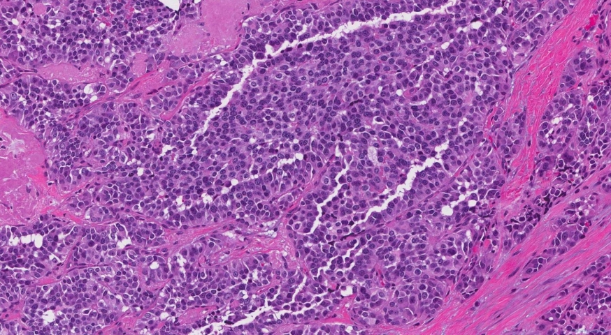 Medullary thyroid carcinoma