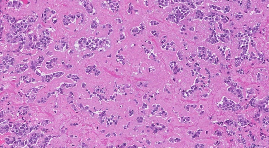 Medullary thyroid carcinoma