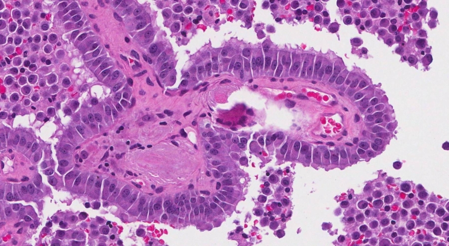 Medullary thyroid carcinoma