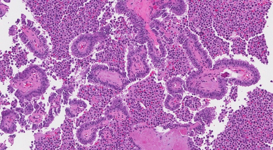 Medullary thyroid carcinoma