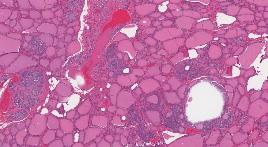 Medullary thyroid carcinoma in a patient with MEN2A