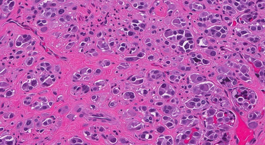 Medullary thyroid carcinoma