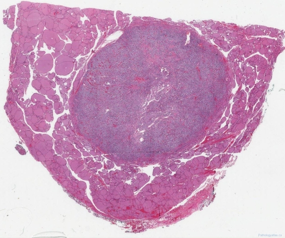 Medullary thyroid carcinoma
