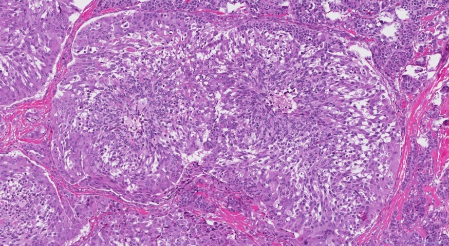 Medullary thyroid carcinoma