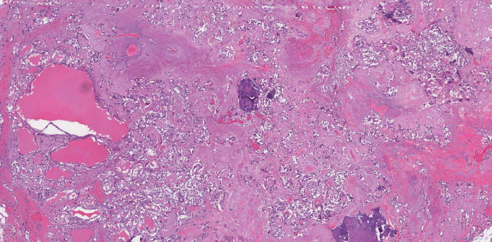 Metastatic medullary thyroid carcinoma and papillary thyroid carcinoma to a lymph node
