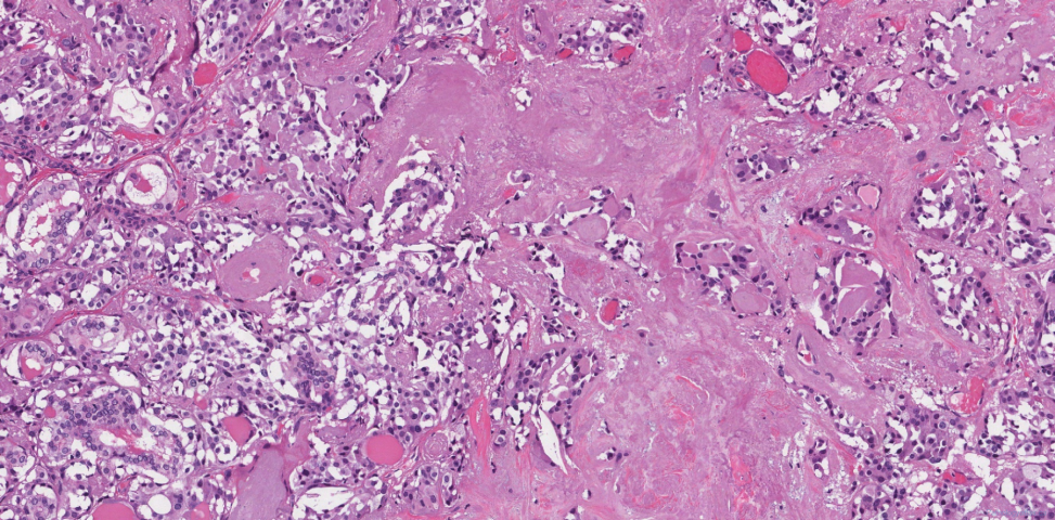 Metastatic medullary thyroid carcinoma and papillary thyroid carcinoma to a lymph node