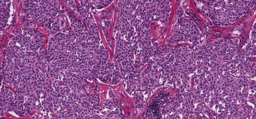 Metastatic medullary thyroid carcinoma to a lymph node