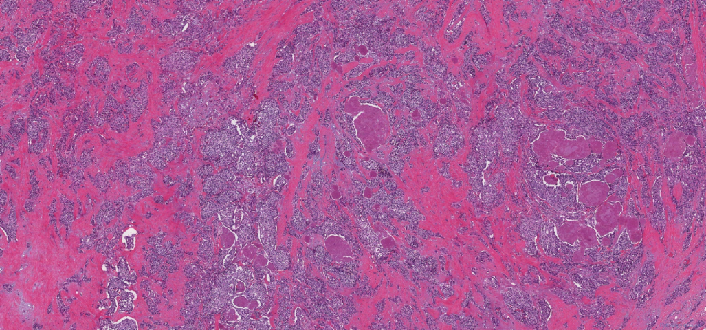 Metastatic medullary thyroid carcinoma to a lymph node