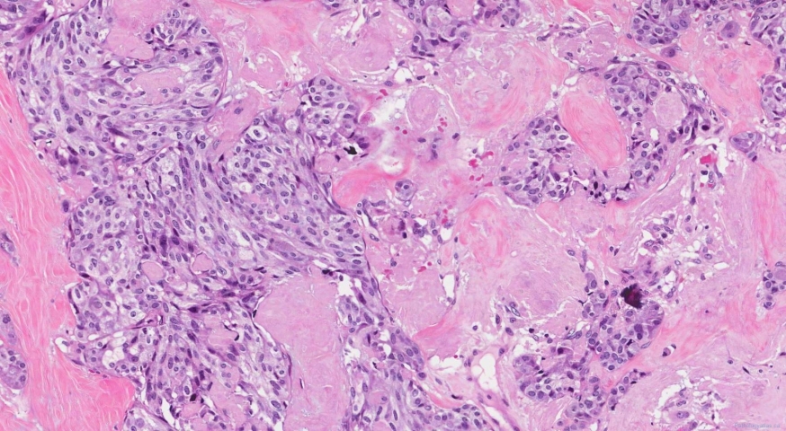 Medullary thyroid carcinoma