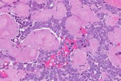 Medullary thyroid carcinoma