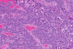 Medullary thyroid carcinoma
