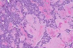 Medullary thyroid carcinoma