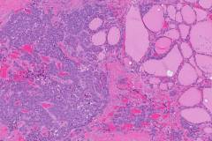 Medullary thyroid carcinoma