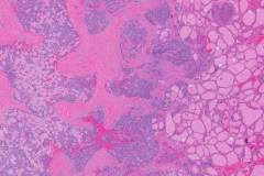 Medullary thyroid carcinoma