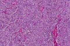 Medullary thyroid carcinoma