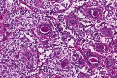 Medullary thyroid carcinoma