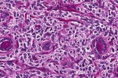 Medullary thyroid carcinoma