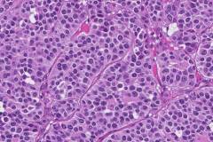 Medullary thyroid carcinoma